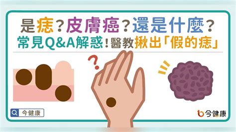 臉上突然長痣怎麼辦|是痣？皮膚癌？還是什麼？常見Q&A解惑！醫教揪出「。